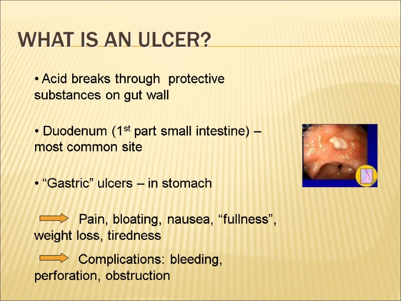 What is an ulcer?  Acid breaks through  protective substances on gut wall